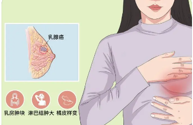 三阴乳腺癌化疗方案