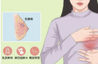 三阴乳腺癌化疗方案